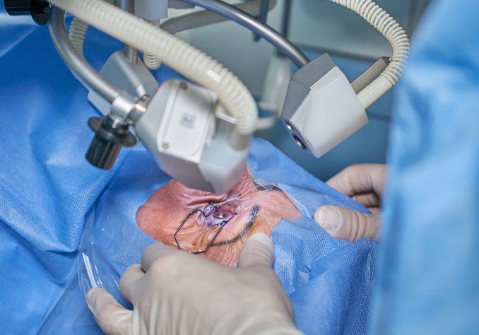 Cirugía de Cataratas