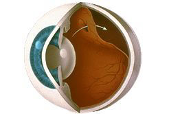 Desprendimiento de Retina