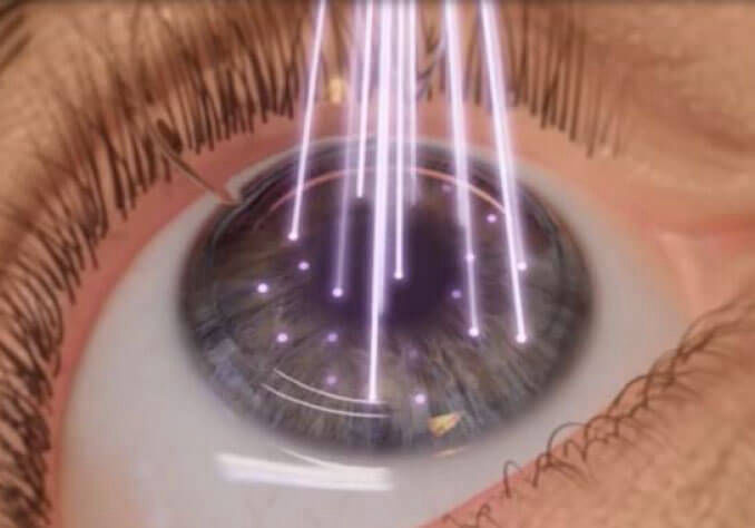 Cirugía Refrectiva, Excimer Láser